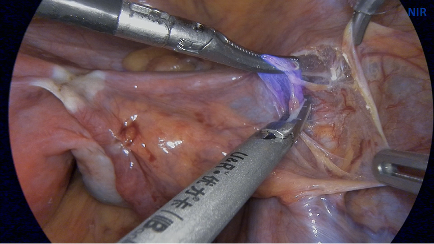 Sentinel lymph node tracing of Cervical Cancer, Endometrial Cancer and Vulvar Cancer